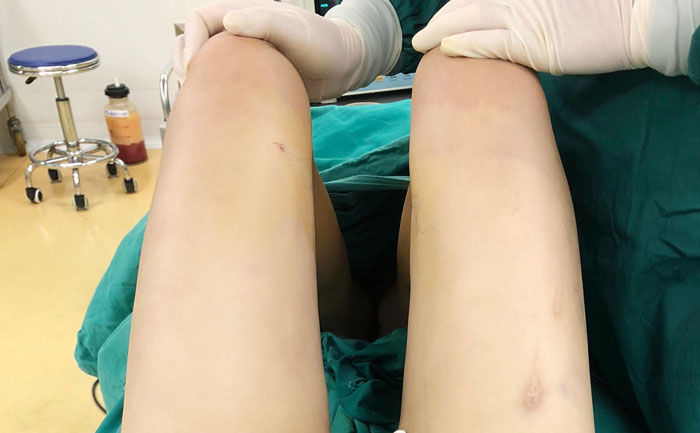 腿部吸脂手術(shù)多少錢？腿部吸脂會不會留下后遺癥？