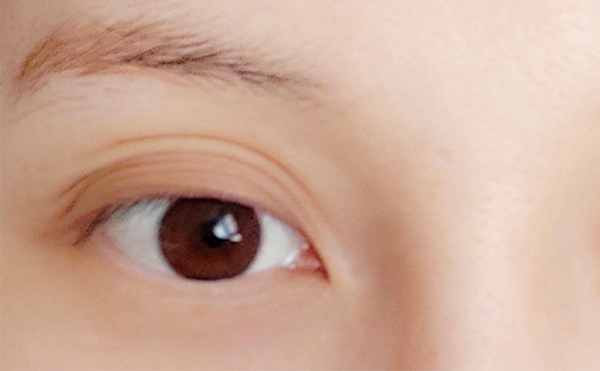 那雙眼皮變多眼皮怎么辦?如何改善多眼皮?