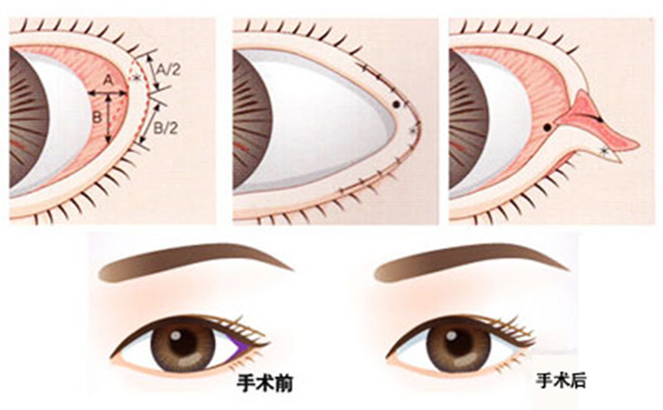 開外眼角有什么后遺癥?開外眼角效果明顯嗎?