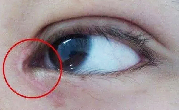 內(nèi)眼角修復難不難？哪些情況需要修復?