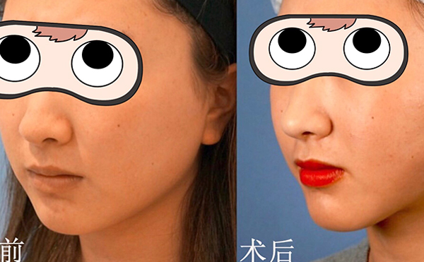 部吸脂有什么優(yōu)勢(shì)?術(shù)后臉下垂是怎么回事?