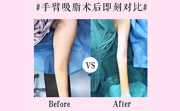 手臂吸脂會(huì)反彈嗎？
