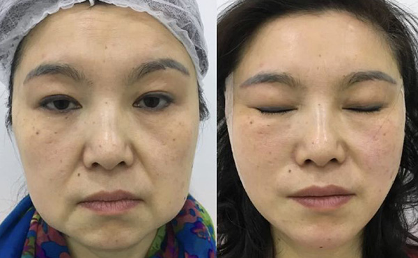 超聲刀適合哪些人群？