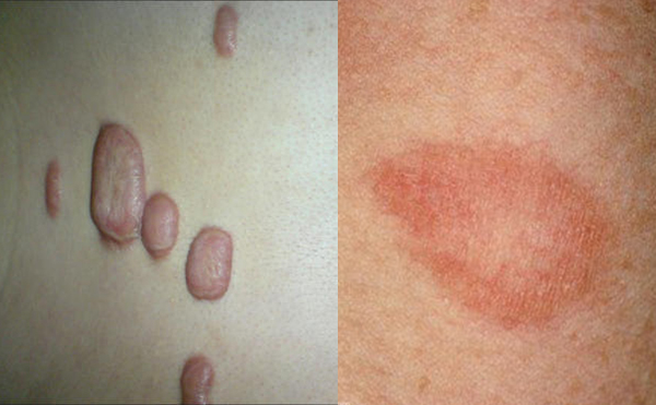 激光去頸紋有并發(fā)癥嗎？