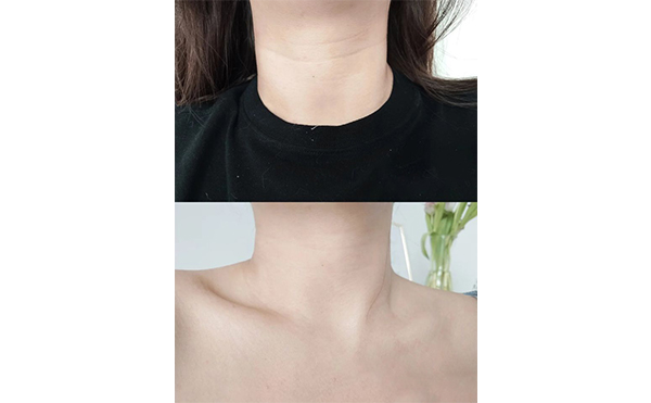 超聲刀去頸紋一年可以做幾次？