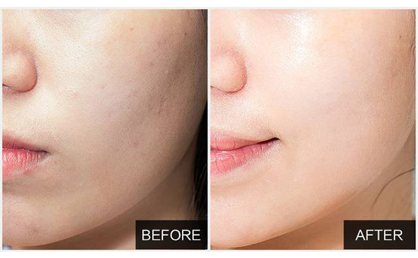 水光針能維持多久？