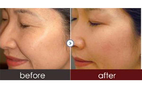 水光針有副作用嗎？