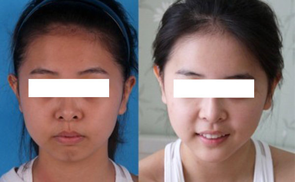 激光美白有什么優(yōu)缺點(diǎn)？