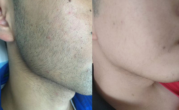 冰點面部脫毛效果怎么樣？