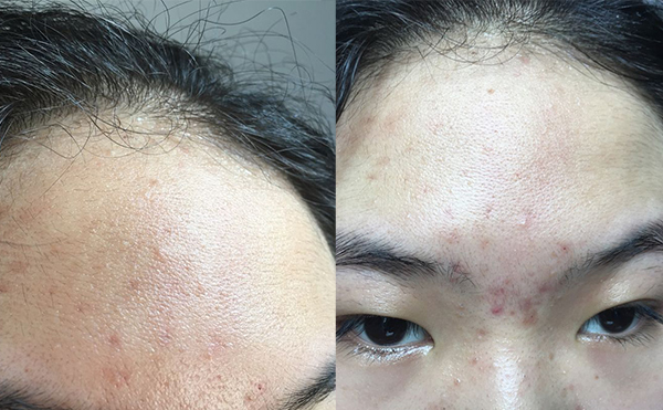 哪些人不適合做冰點面部脫毛？