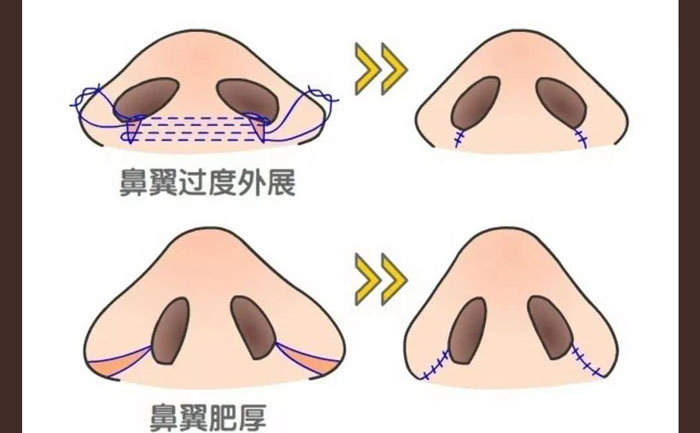 鼻頭肥大怎么改善？鼻頭肥大矯正術(shù)多少錢？