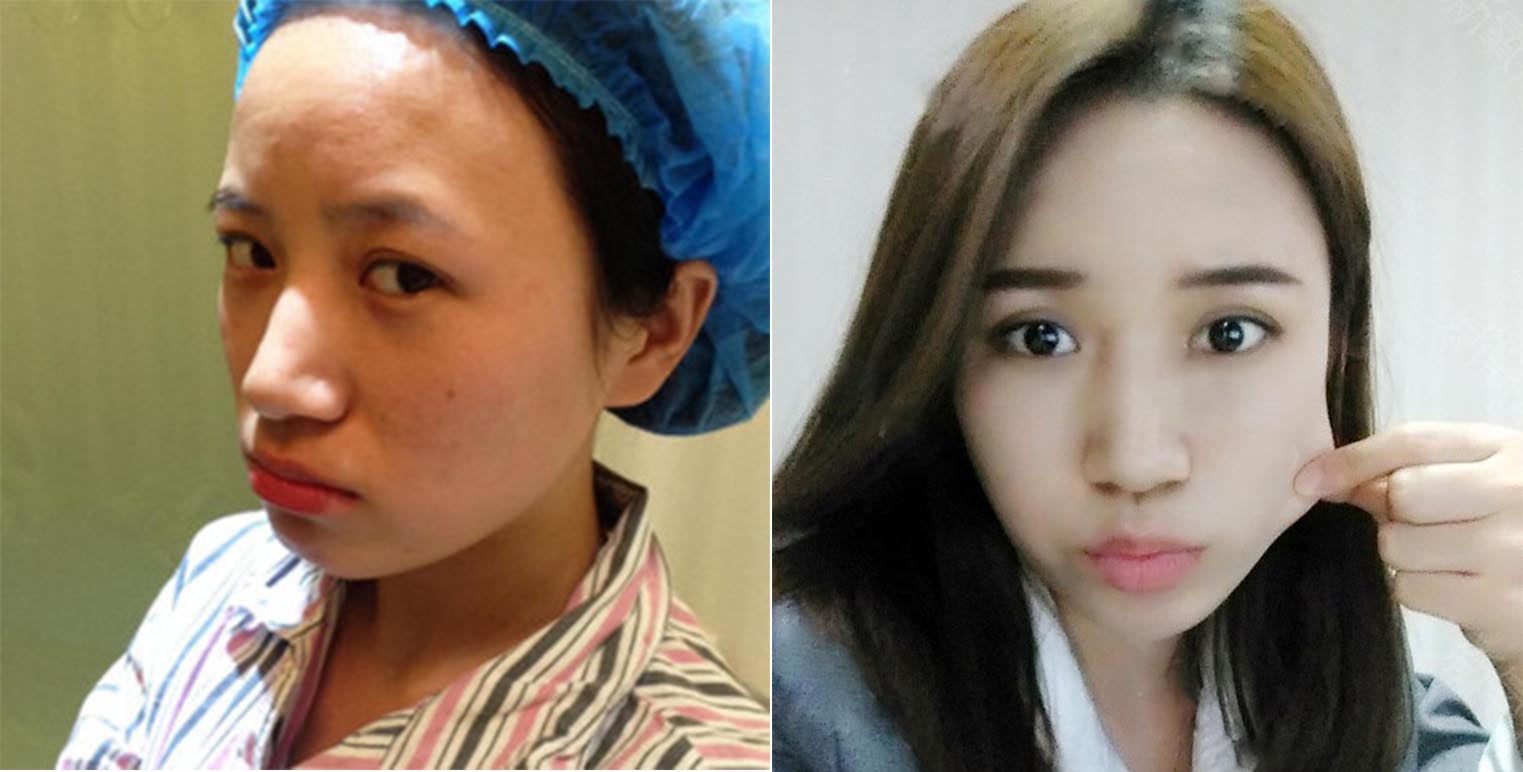 全臉脂肪填充效果對比圖