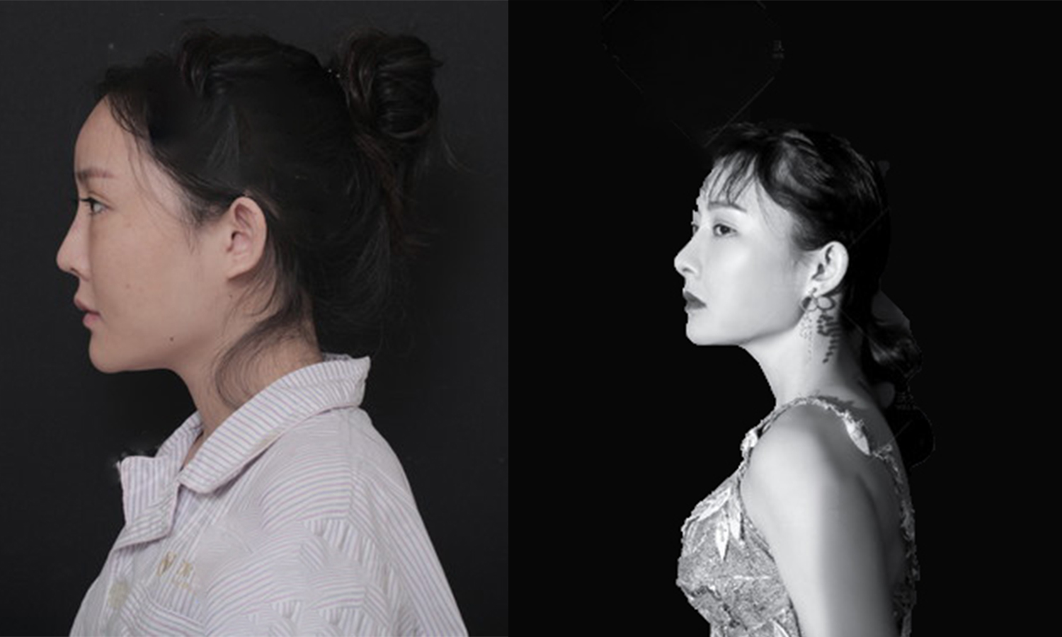 肋骨隆鼻手術效果圖