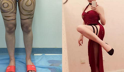 大腿吸脂前后效果對比圖