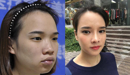 鄭州壹加壹假體下巴