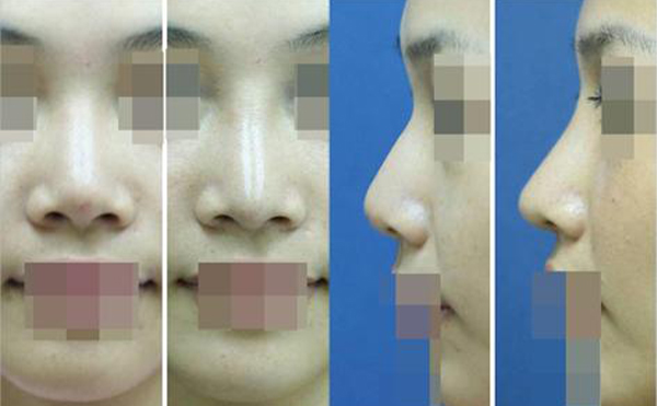 膨體隆鼻前后對(duì)比效果
