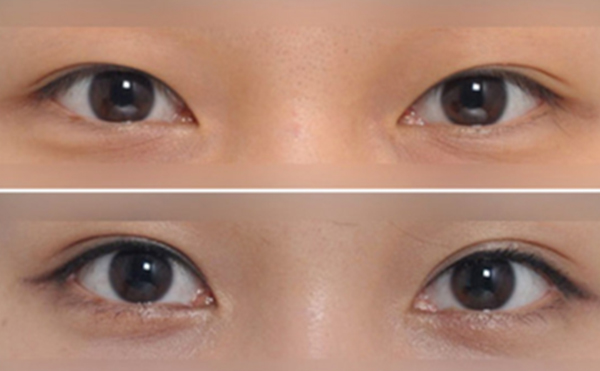 哪種雙眼皮術(shù)后恢復(fù)的更快?埋線雙眼皮術(shù)后如何修復(fù)呢?
