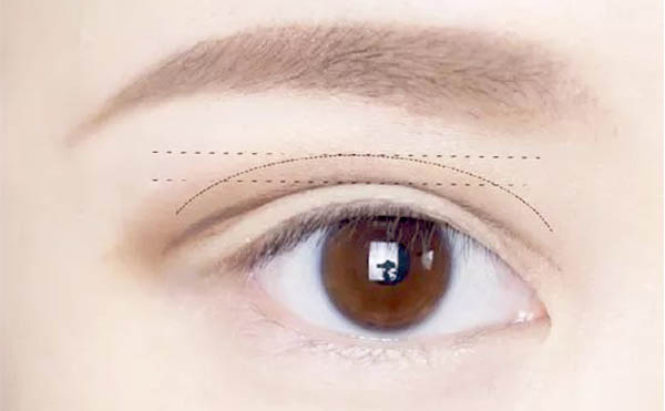 雙眼皮手術(shù)費用一般是多少?術(shù)前有什么注意事項?