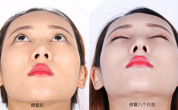 隆鼻手術(shù)失敗怎么辦？修復費用要多少？