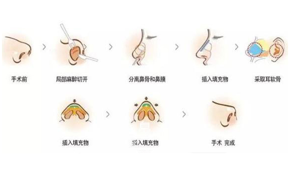 耳軟骨隆鼻效果怎么樣？要多少錢？