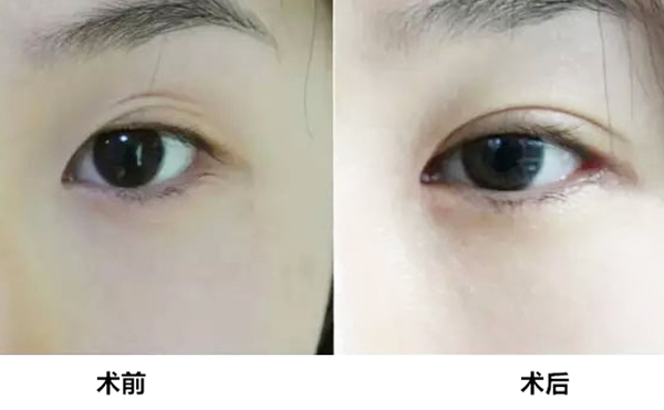 切開(kāi)雙眼皮手術(shù)做失敗了怎么辦?
