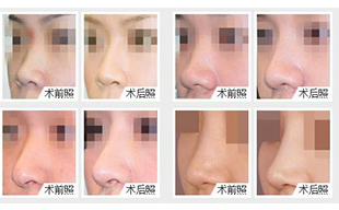 玻尿酸隆鼻好還是假體隆鼻好？更推薦哪一種？