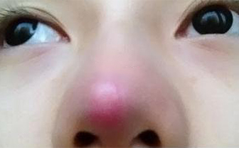 術后鼻頭發(fā)紅是隆鼻手術失敗了嗎？該怎么處理？