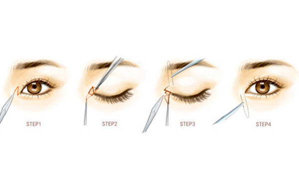 開內(nèi)眼角是什么價格?術(shù)后有什么注意事項(xiàng)?