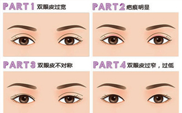 雙眼皮失敗有哪些明顯表現(xiàn)？修復(fù)成功率大嗎？