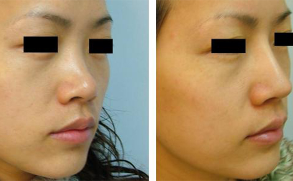 隆鼻手術(shù)有沒有什么后遺癥？