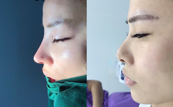 做隆鼻手術(shù)需要滿足什么條件？月經(jīng)期間可以做隆鼻手術(shù)嗎？
