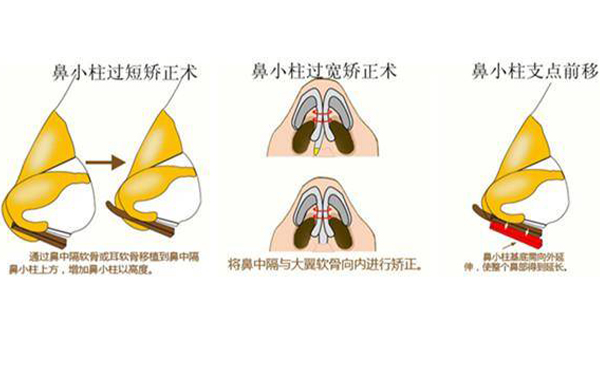 鼻小柱缺損修復(fù)有幾種方法？為什么會(huì)出現(xiàn)鼻小柱缺損的情況