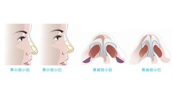 鼻翼縮小整形安全嗎？術后會不會影響呼吸