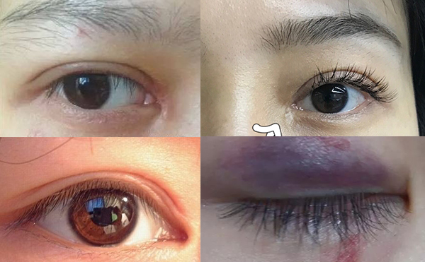 開內(nèi)眼角容易留疤嗎?開內(nèi)眼角危害大不大?