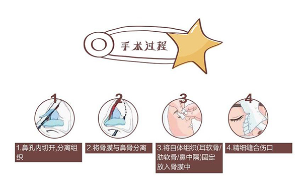自體軟骨隆鼻為什么這么受歡迎？