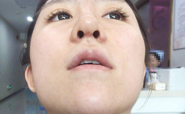 有沒有不做手術讓鼻孔縮小的方法?捏鼻子有用嗎?