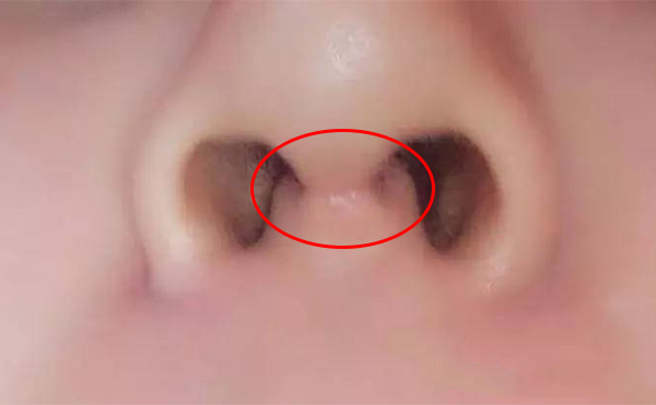 假體隆鼻的切口會(huì)不會(huì)留下疤痕?