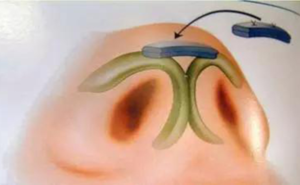 鼻小柱缺損修復(fù)手術(shù)有風(fēng)險嗎?術(shù)前注意事項(xiàng)有哪些?