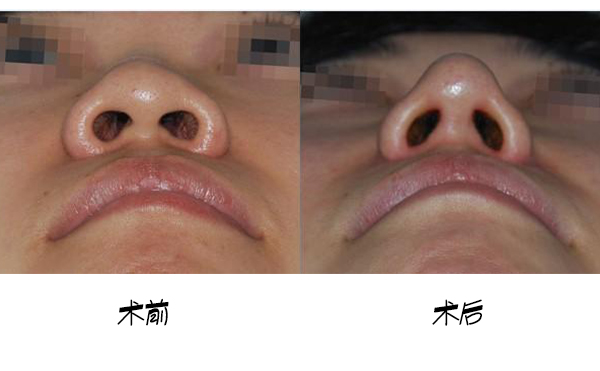 鼻小柱延長手術(shù)的大致流程是什么？手術(shù)成功率高嗎