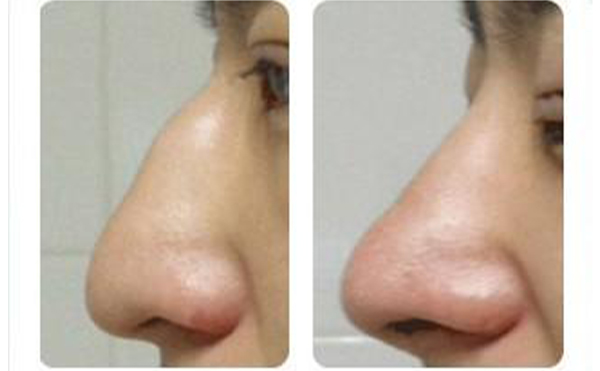 駝峰鼻矯正有哪些方法？