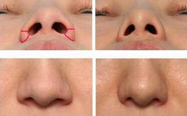 哪些人適合做鼻孔縮小？一般會(huì)用什么方法來達(dá)到縮小鼻孔的目的