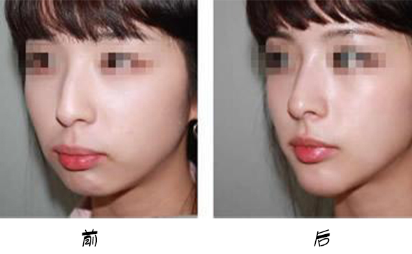 箭鼻是怎么出現(xiàn)的?箭鼻矯正是如何操作的？