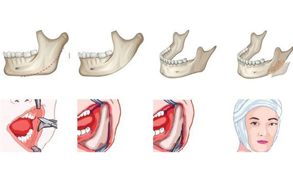 哪些人不能做下頜角切除手術(shù)？