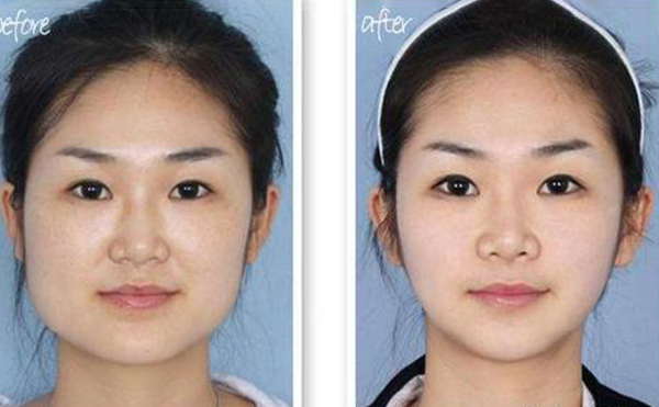 下頜整形術(shù)后護(hù)理