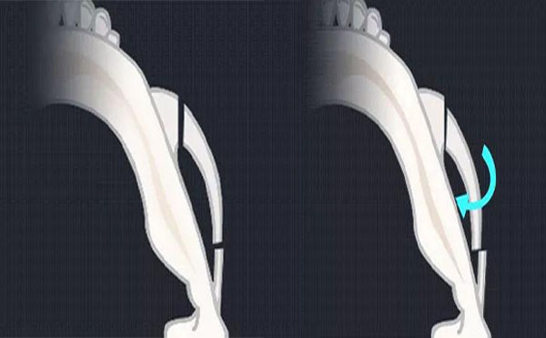 顴骨內(nèi)推是什么？