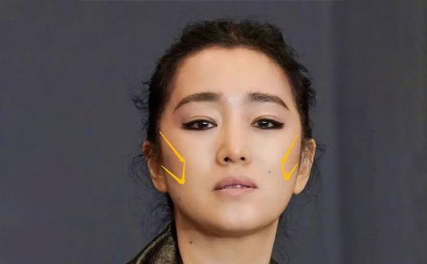 什么原因導致顴骨外擴？