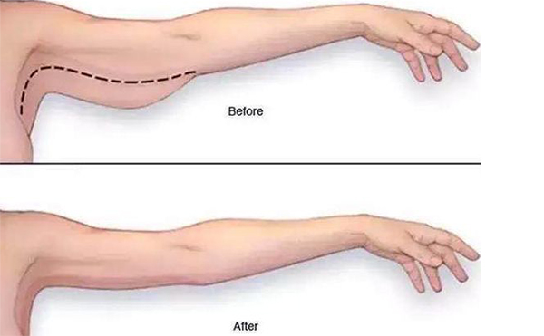 手臂吸脂需要多長(zhǎng)時(shí)間恢復(fù)？