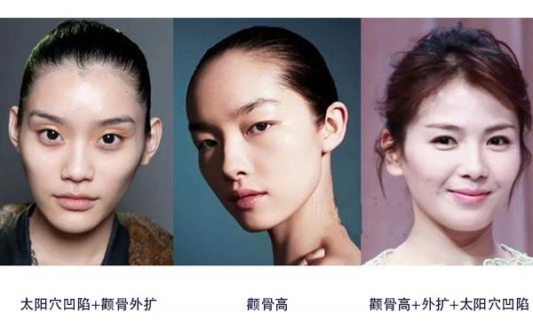 怎么區(qū)分是顴骨高還是太陽穴凹陷？