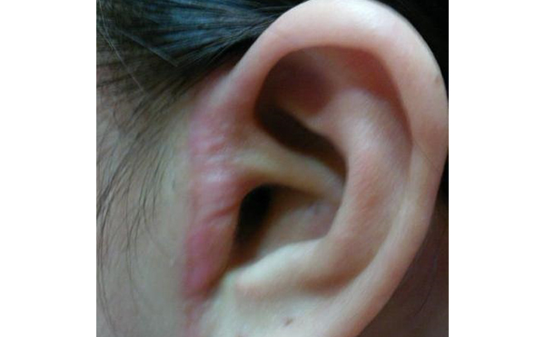 拉皮痕跡明顯嗎？