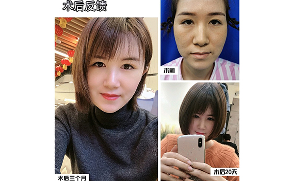 電波拉皮除皺的步驟是什么？